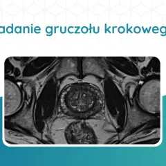 Przekrój rezonansu magnetycznego miednicy, ukazujący badanie prostaty.