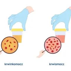 Podwyższony poziom erytrocytów: przyczyny, objawy i zagrożenia zdrowotne