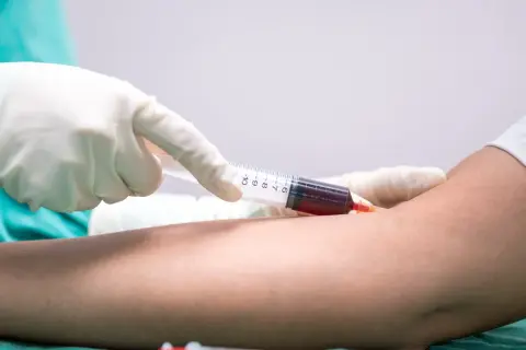 Pobieranie krwi do badań. Lekarz w rękawiczce pobiera strzykawką krew, która może wskazywać, że mpv za wysokie.