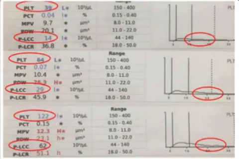 Wyniki badań krwi z zaznaczonymi parametrami P-LCC i P-LCR. Wartości P-LCR są w normie.