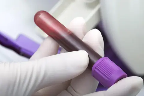 Ręka w białej rękawiczce trzyma probówkę z krwią. Badanie poziomu lipazy jest kluczowe.
