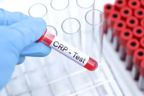 Ręka w niebieskiej rękawiczce trzyma probówkę z napisem "CRP - Test". To badanie pomaga ocenić stan zapalny w organizmie.