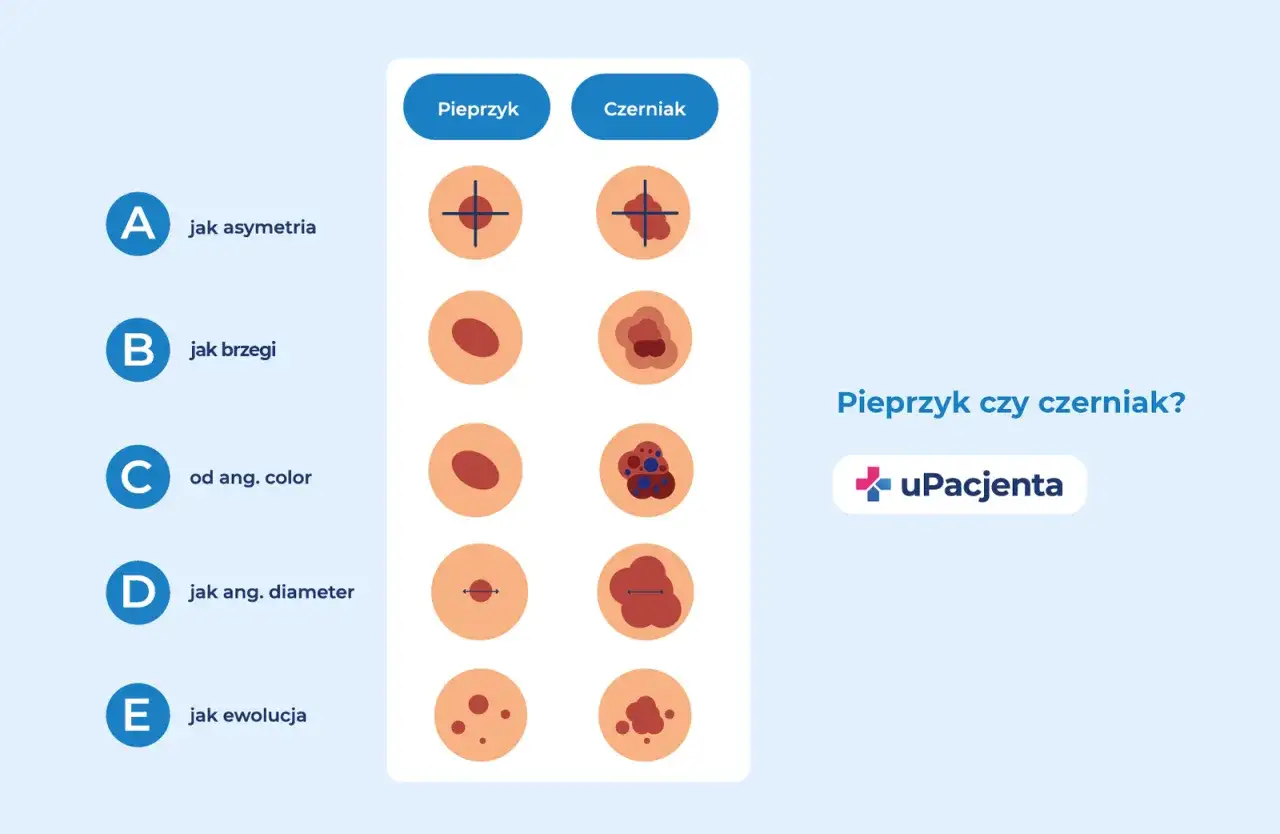 Czerniak - jak rozpoznać niepokojące znamię?