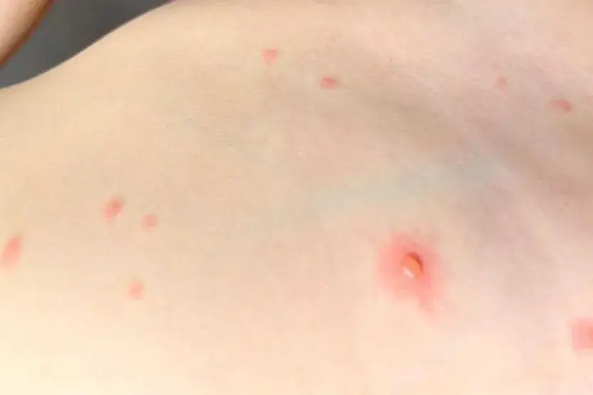 Zdjęcie Jaki lek na gorączkę przy ospie? Paracetamol czy ibuprofen?