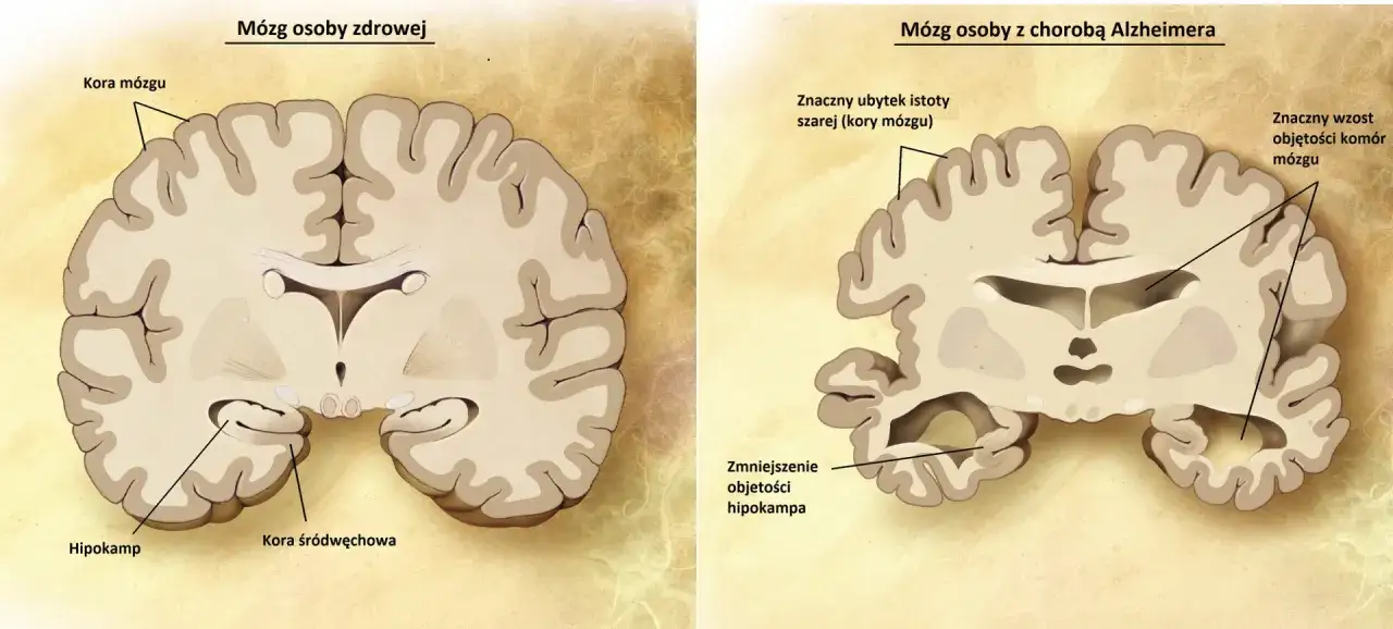 Porównanie przekrojów mózgu osoby zdrowej i z chorobą Alzheimera, ukazujące zmiany.