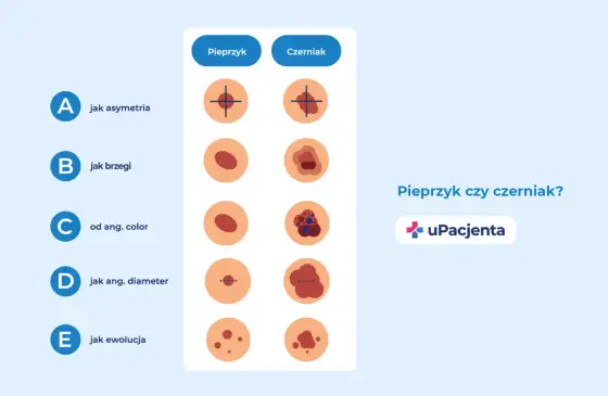 Czerniak - jak rozpoznać niepokojące znamię?