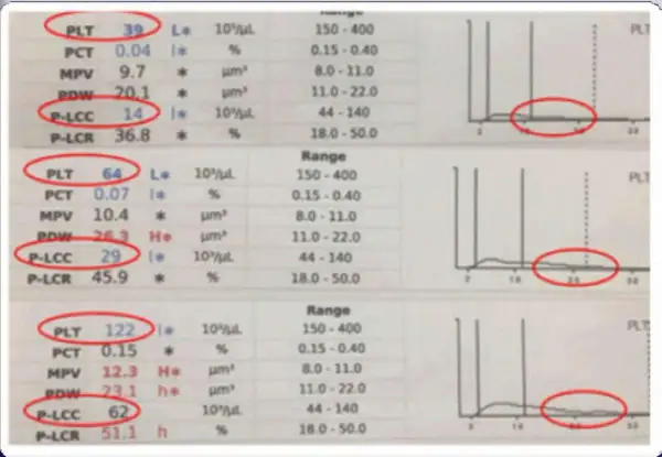Wyniki badań krwi z zaznaczonymi parametrami P-LCC i P-LCR. Wartości P-LCR są w normie.